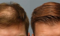 Hair Transplant Antalya – Haarex Clinic