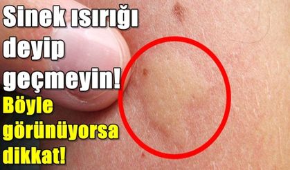 Sivrisinek ısırığı böyle görünüyorsa DİKKAT!