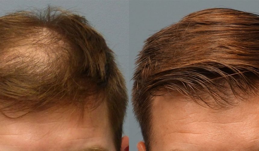 Hair Transplant Antalya – Haarex Clinic